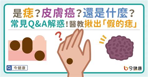 內痣是什麼|是痣？皮膚癌？還是什麼？常見Q&A解惑！醫教揪出「假的痣」